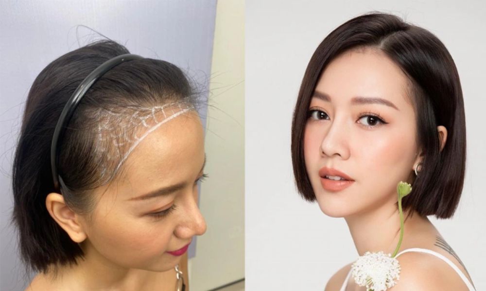 Cấy tóc tự thân là phương pháp điều trị tóc bò liếm triệt để