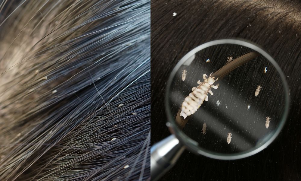 Cảm giác ngứa da đầu là dấu hiệu để nhận biết có chấy trên da đầu